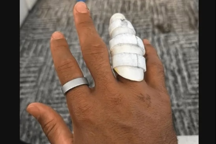 哈特曬術后無名指護具照，湖人后衛線恢復進程引關注